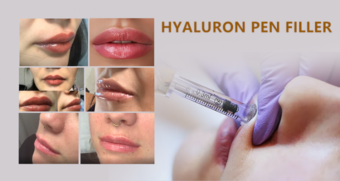 injections d'acide hyaluronique de remplisseurs de lèvre de remplisseurs d'acide hyaluronique pour le traitement 2 de stylo et de micro-aiguille