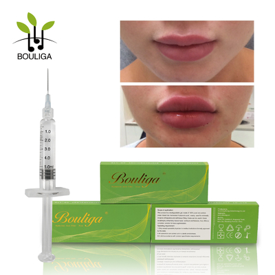 Injections cutanées de haut d'ha acide hyaluronique durable de concentration pour l'amélioration de contournement de lèvre de visage